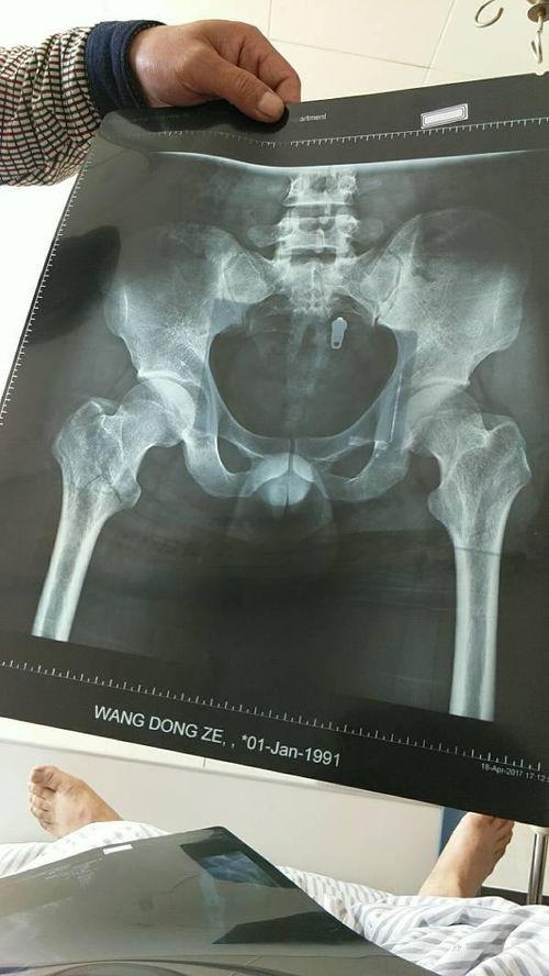 哪些明星腿骨折严重的,腿断筋折！盘点那些因严重骨折而休养的明星